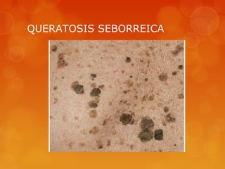 QUERATOSIS SEBORREICA
 