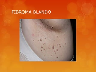 FIBROMA BLANDO
 