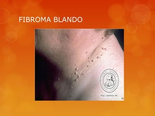 FIBROMA BLANDO
 