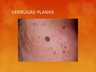 VERRUGAS PLANAS
 