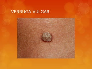 VERRUGA VULGAR
 