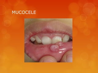 MUCOCELE
 