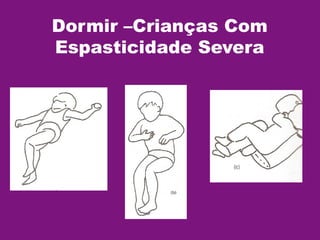 Dormir –Crianças Com
Espasticidade Severa
 