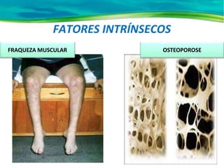 FATORES INTRÍNSECOS
OSTEOPOROSE
FRAQUEZA MUSCULAR
 