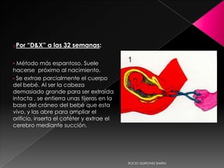 oPor “D&X” a las 32 semanas:
• Método más espantoso. Suele
hacerse próximo al nacimiento.
• Se extrae parcialmente el cuerpo
del bebé. Al ser la cabeza
demasiado grande para ser extraída
intacta , se entierra unas tijeras en la
base del cráneo del bebé que esta
vivo, y las abre para ampliar el
orificio, inserta el catéter y extrae el
cerebro mediante succión.
ROCIO QUIÑONEZ BARRA
 