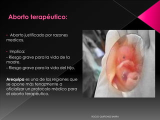 • Aborto justificado por razones
medicas.
• Implica:
- Riesgo grave para la vida de la
madre.
- Riesgo grave para la vida del hijo.
Arequipa es una de las regiones que
se opone más tenazmente a
oficializar un protocolo médico para
el aborto terapéutico.
ROCIO QUIÑONEZ BARRA
 