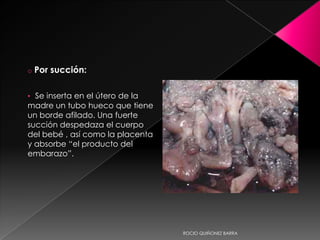 o   Por succión:

• Se inserta en el útero de la
madre un tubo hueco que tiene
un borde afilado. Una fuerte
succión despedaza el cuerpo
del bebé , así como la placenta
y absorbe “el producto del
embarazo”.




                                  ROCIO QUIÑONEZ BARRA
 