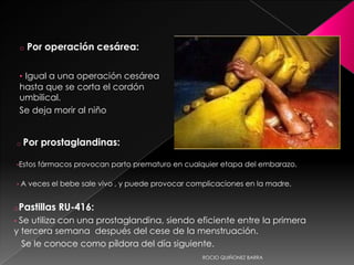 o   Por operación cesárea:

        • Igual a una operación cesárea
        hasta que se corta el cordón
        umbilical.
        Se deja morir al niño


    o   Por prostaglandinas:

    •Estos    fármacos provocan parto prematuro en cualquier etapa del embarazo.

    •   A veces el bebe sale vivo , y puede provocar complicaciones en la madre.


oPastillas         RU-416:
•Se utiliza con una prostaglandina, siendo eficiente entre la primera
y tercera semana después del cese de la menstruación.
  Se le conoce como píldora del día siguiente.
                                                        ROCIO QUIÑONEZ BARRA
 