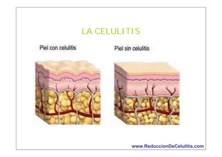 LA CELULITIS

www.ReduccionDeCelulitis.com

 
