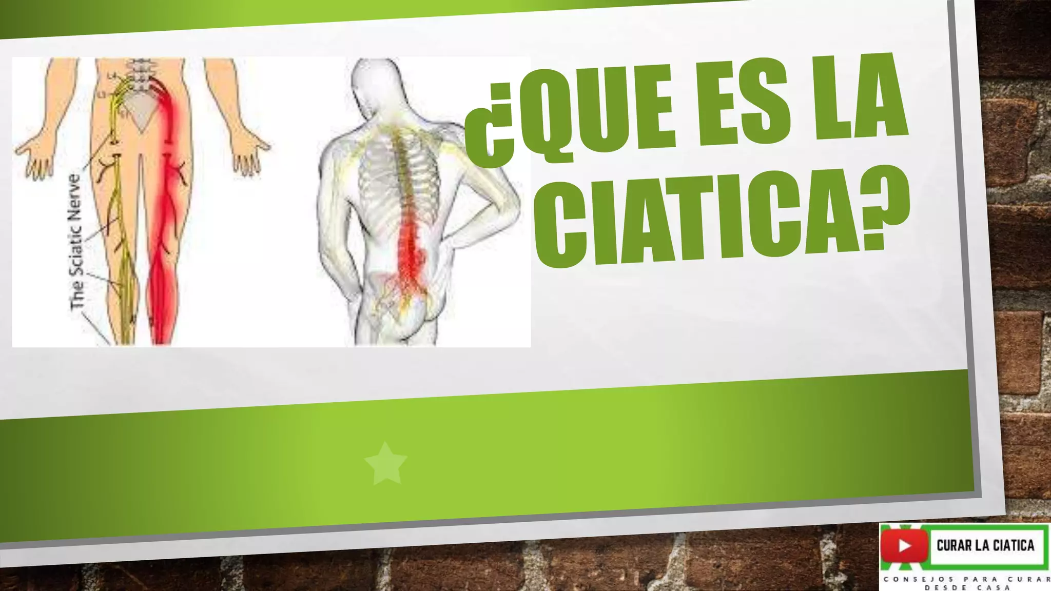 Que es la ciatica PPT