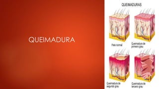 QUEIMADURA 
 