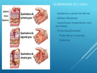 QUEIMADURA DE 2 GRAU
- Epiderme e parte da derme
- Bolhas (flictenas)
- Superficiais (tratamento com
pomadas)
- Profundas(Enxertia)
- Pode deixar cicatrizes
- Dolorosa
 