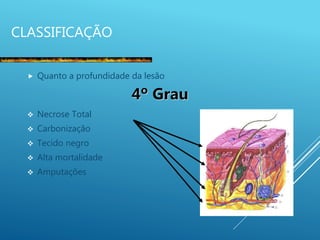 CLASSIFICAÇÃO
 Quanto a profundidade da lesão
4º Grau
 Necrose Total
 Carbonização
 Tecido negro
 Alta mortalidade
 Amputações
 