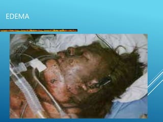 EDEMA
 
