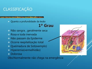 CLASSIFICAÇÃO
 Quanto a profundidade da lesão
1º Grau
 Não sangra , geralmente seca
 Rosa e toda inervada
 Não passam da Epiderme
 Ocorre reepitelização total
 Queimadura de Sol(exemplo)
 Hiperemia(vermelhidão)
 Dolorosa
Obs:Normalmente não chega na emergência
 