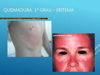 QUEIMADURA 1º GRAU – ERITEMA
 