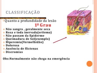 CLASSIFICAÇÃO
𝗈 Quanto a profundidade da lesão
1º Grau
❖ Não sangra , geralmente seca
❖ Rosa e toda inervada(eritema)
❖ Não passam da Epiderme
❖ Queimadura de Sol(exemplo)
❖ Hiperemia(Vermelhidão)
❖ Dolorosa
❖ Ausência de flictenas
❖ Discromias
Obs:Normalmente não chega na emergência
 