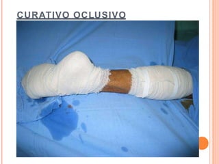 CURATIVO OCLUSIVO
 