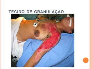 TECIDO DE GRANULAÇÃO
 