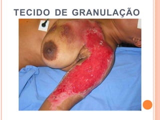 TECIDO DE GRANULAÇÃO
 