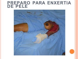 PREPARO PARA ENXERTIA
DE PELE
 