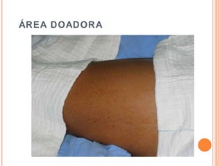 ÁREA DOADORA
 