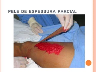 PELE DE ESPESSURA PARCIAL
 