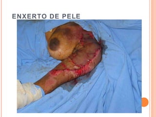 ENXERTO DE PELE
 
