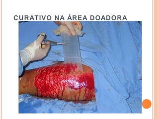 CURATIVO NA ÁREA DOADORA
 