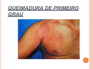 QUEIMADURA DE PRIMEIRO
GRAU
 