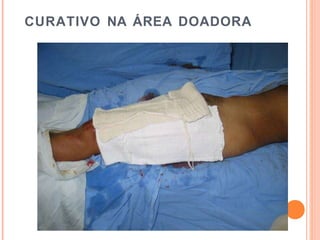 CURATIVO NA ÁREA DOADORA
 