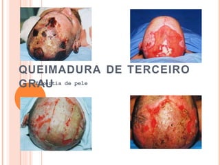 QUEIMADURA DE TERCEIRO
GRE
A
nxe
U
rtia de pele
 