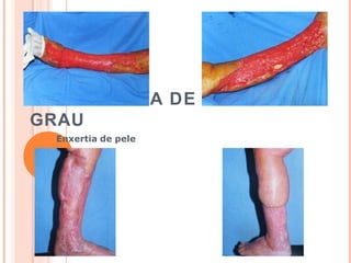 QUEIMADURA DE TERCEIRO
GRAU
Enxertia de pele
 