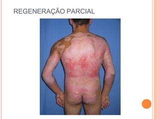 REGENERAÇÃO PARCIAL
 