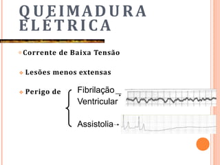 Q U EIMADURA
ELÉTRICA
𝗈 Corrente de Baixa Tensão
❖ Lesões menos extensas
❖ Perigo de Fibrilação
Ventricular
Assistolia
 