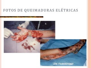 FOTOS DE QUEIMADURAS ELÉTRICAS
 