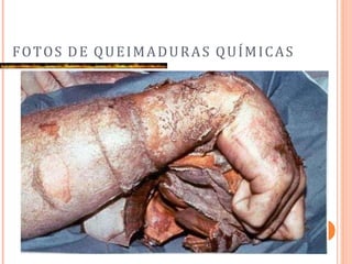 FOTOS DE QUEIMADURAS QUÍMICAS
 