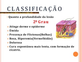 C L A SSIFICA ÇÃ O
𝗈 Quanto a profundidade da lesão
2º Grau
❖ Atinge derme e epiderme
❖ Úmida
❖ Presença de Flictenas(Bolhas)
❖ Rosa, Hiperemia(Vermelhidão)
❖ Dolorosa
❖ Cura espontânea mais lenta, com formação de
cicatriz.
 