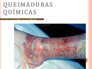 QU EIMADU RAS
QUÍMICAS
 