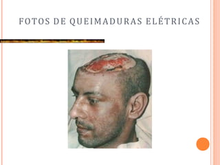 FOTOS DE QUEIMADURAS ELÉTRICAS
 