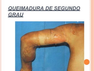 QUEIMADURA DE SEGUNDO
GRAU
 