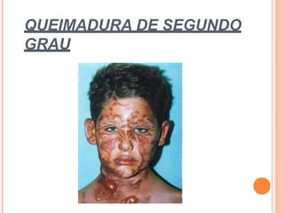 QUEIMADURA DE SEGUNDO
GRAU
 