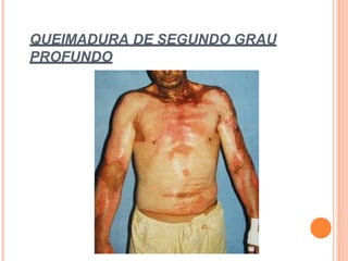 QUEIMADURA DE SEGUNDO GRAU
PROFUNDO
 