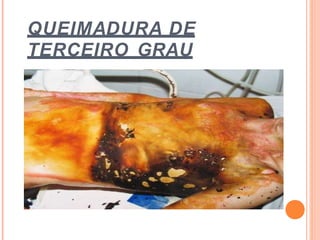 QUEIMADURA DE
TERCEIRO GRAU
 