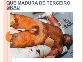 QUEIMADURA DE TERCEIRO
GRAU
 