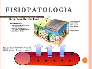 FISIOPATOLOGIA
Extravasamento de Plasma
(Eletrólitos , Proteínas e etc)
 