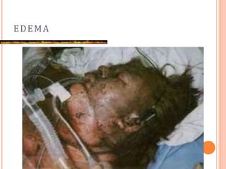 EDEMA
 
