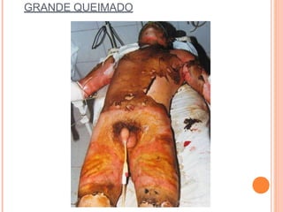 GRANDE QUEIMADO
 