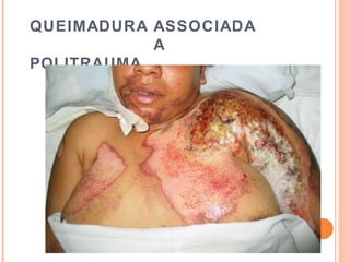 QUEIMADURA ASSOCIADA
A
POLITRAUMA
 