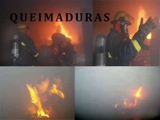 QUEIMADURAS
 
